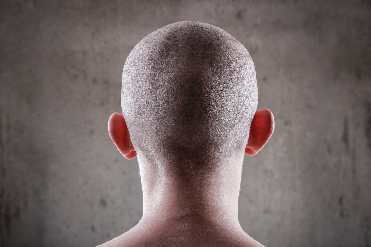 Androgenetischer Alopezie bei Männern - was dagegen hilft