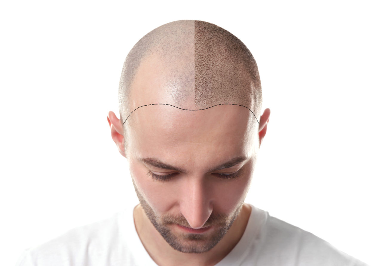 DHI Haartransplantation Methode bei Männern