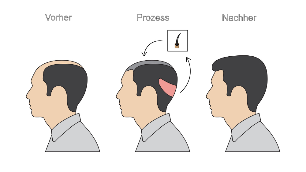 Infografik über den Ablauf einer Haartransplantation. Vorher- und Nachervergleich